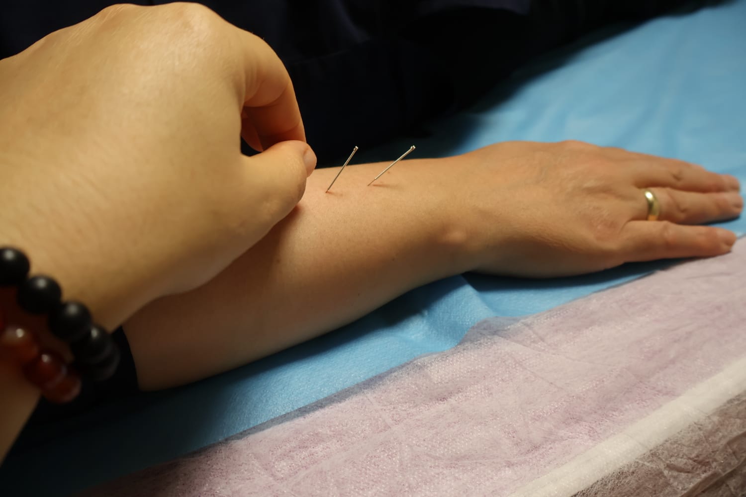 Akupunktur Nedir ?